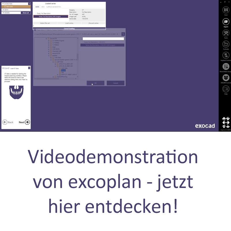 Exocad Exoplan Software Videodemo Link